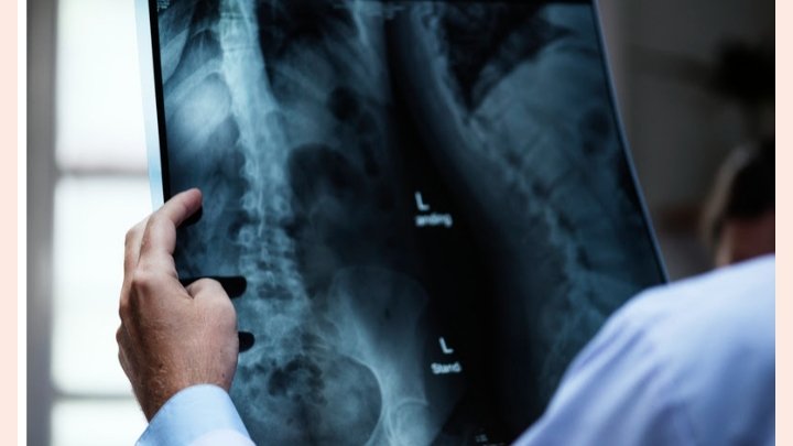 ONG Mude a Curva realiza mutirão de cirurgias de escoliose em parceria com HCFMB e Medtronic, ampliando acesso pelo SUS   