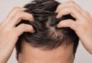 Especialista alerta para cuidados com o couro cabeludo masculino