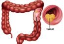 Desconhecimento e procrastinação: inimigos que transformam o câncer colorretal no segundo tumor de maior incidência no Brasil