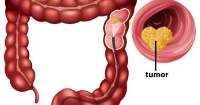 Desconhecimento e procrastinação: inimigos que transformam o câncer colorretal no segundo tumor de maior incidência no Brasil Desconhecimento e procrastinação: inimigos que transformam o câncer colorretal no segundo tumor de maior incidência no Brasil